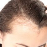 How to Take Care of Hair Loss